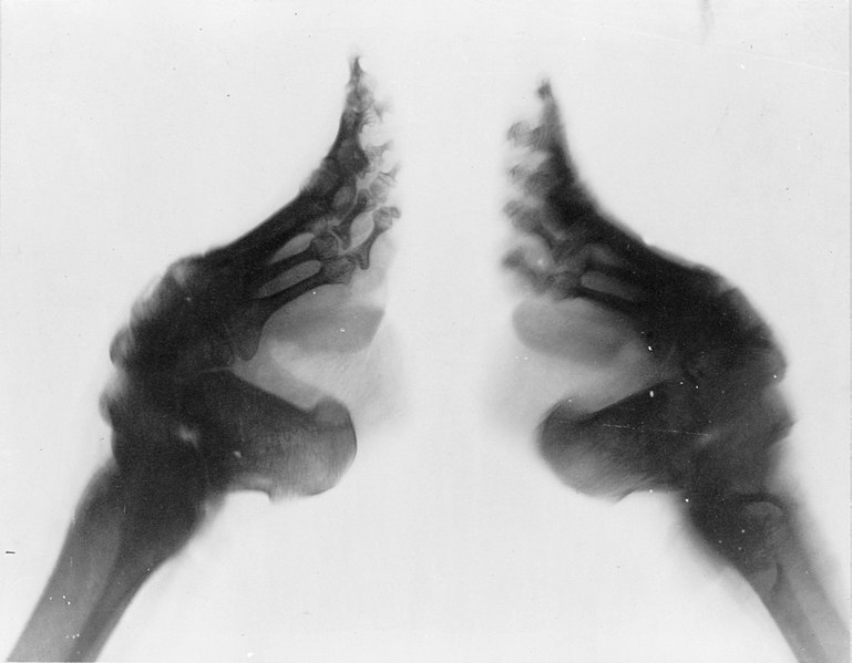Fil:Bound feet (X-ray).jpg