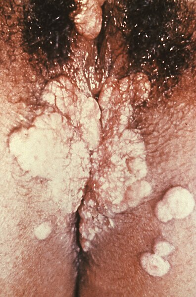 Fil:Vaginal syphilis (disturbing image).jpg