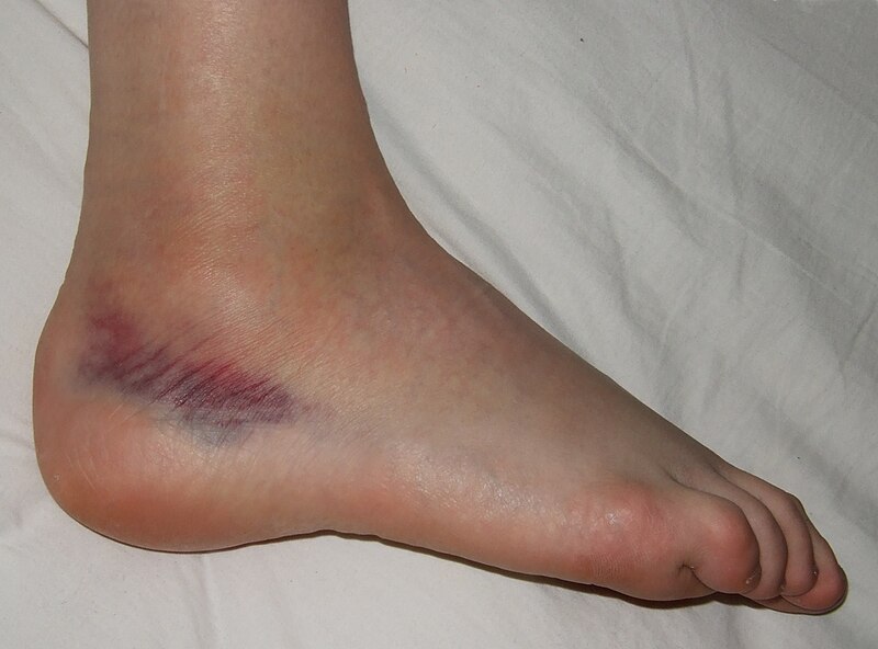Fil:Sprained foot.jpg