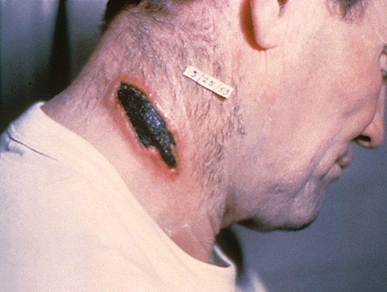 Fil:Cutaneous anthrax lesion on the neck. PHIL 1934 lores.jpg