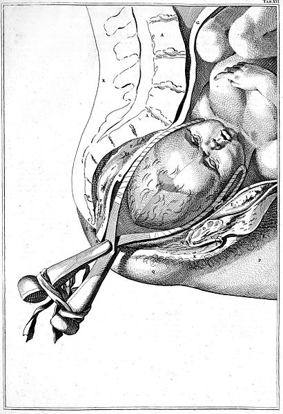 Fil:Smellie forceps.jpg