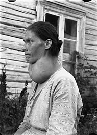 En kvinna med en enorm struma (grad III). I västvärlden upptäcks och åtgärdas struma innan den blivit så här stor.