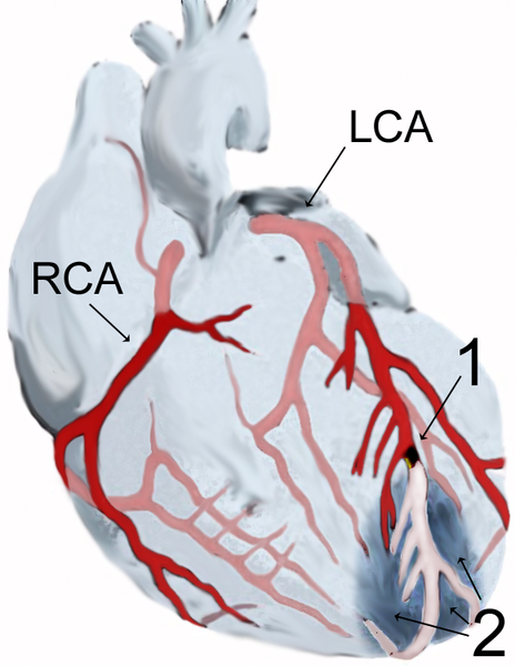 Diagram över en hjärtinfarkt (2) av toppen av främre hjärtväggen efter en ocklusion (1) av en gren av hjärtats koronarkärl (LCA = vänster koronarartär).