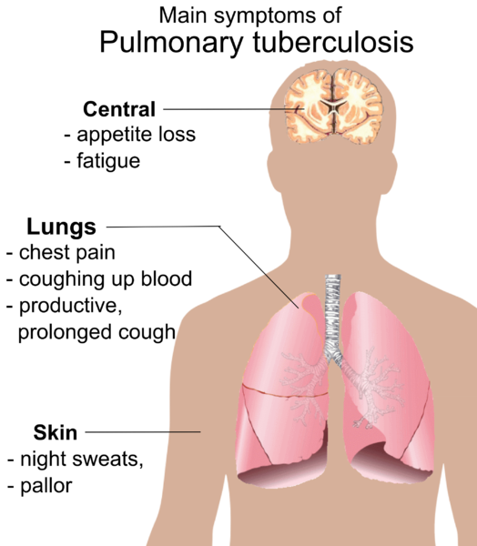Fil:Pulmonary tuberculosis symptoms.png