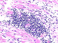 Hisopatologisk bild av viral myokardit vid en biopsi på en patient som dött av hjärtsvikt. Den virala orsaken kunde dock inte fastställas i blodet efter döden.