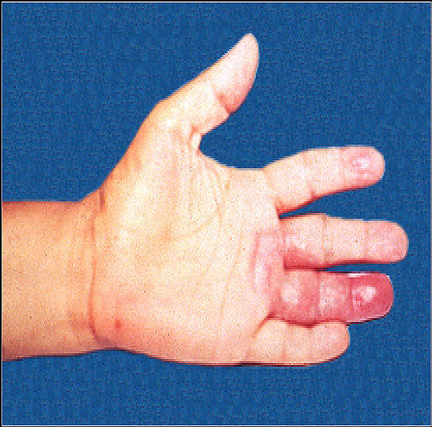 Fil:Leprosy hand affected fourth digit.jpg
