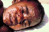 Ett barn med utslag i ansiktet orsakade av smittkoppor