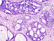 Histopatologisk bild föreställande duktal carcinoma in situ (DCIS) i bröstvävnad. (H&E-färgning)