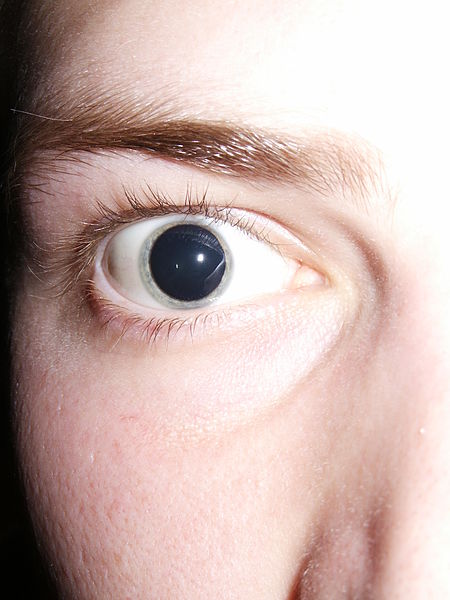 Fil:Dilated pupils 2006.jpg