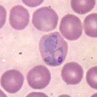 Plasmodium falciparum i en mänsklig röd blodkropp.