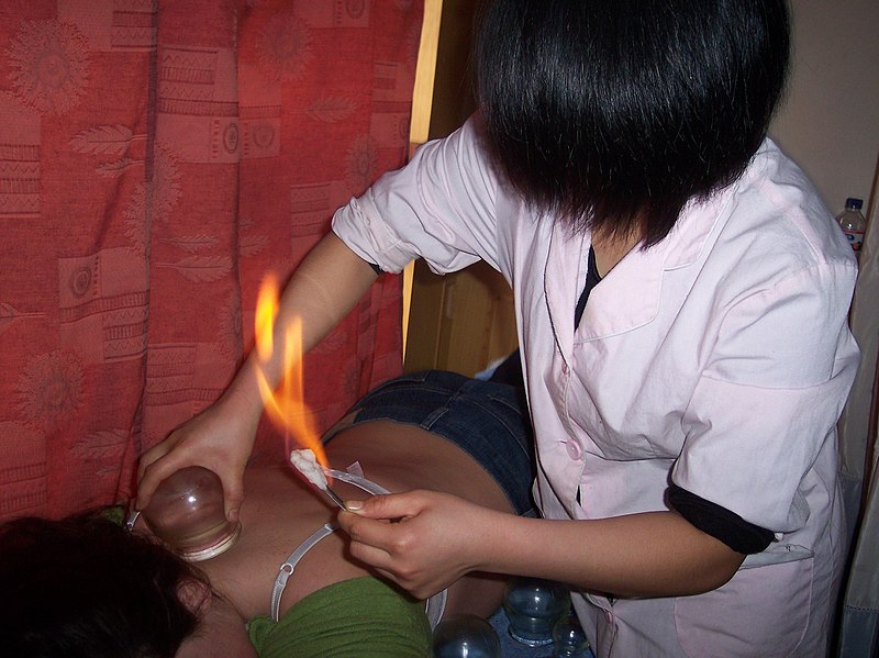 Fil:Fire Cupping.jpg