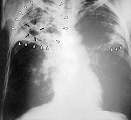 Röntgenbild av lungorna på en patient som lider av tuberkulos.