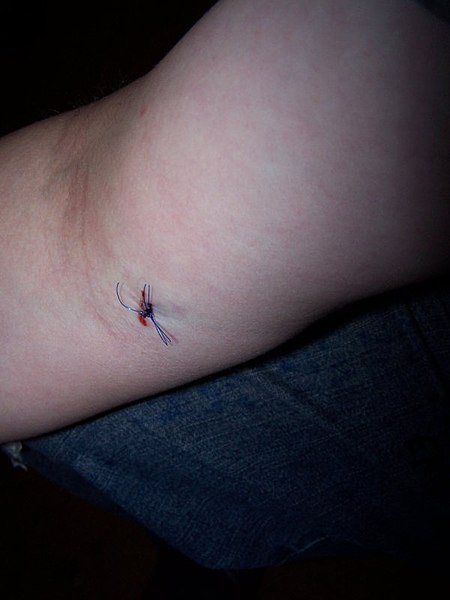 Fil:Suture - Landscaping Accident.jpg