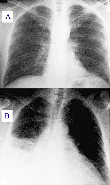 Fil:Pneumonia x-ray.jpg