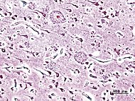 Histopatologisk bild av senila plack sedda i cerebrala cortex hos en  patient med Alzheimers sjukdom med försenil start. Silverfärgning.