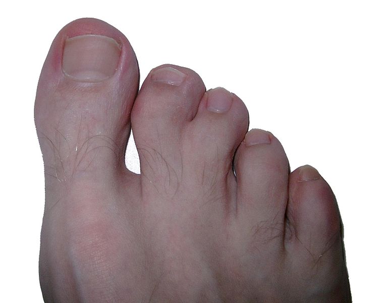 Fil:Syndactily feet.jpg