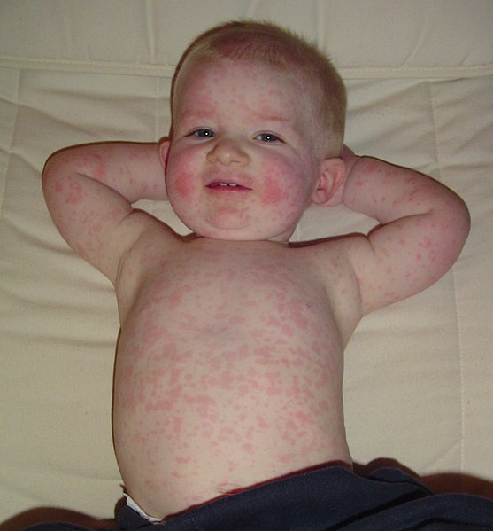 Fil:Fifth disease.jpg