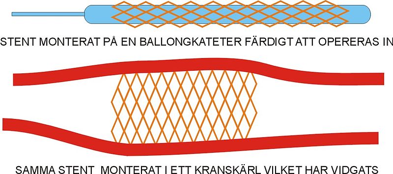 Fil:Stent 2.jpg