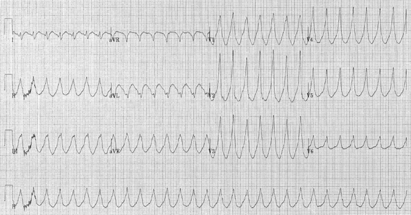 Fil:Electrocardiogram of Ventricular Tachycardia.png