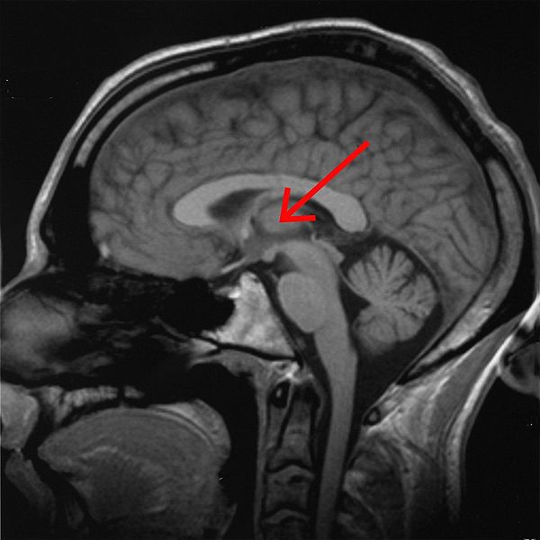 Fil:Brain chrischan thalamus.jpg