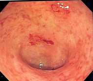Endoskopisk bild av en sigmoidalt kolonsegment drabbat av ulcerös kolit. Notera det vaskulära mönstret av kolon och den fokala fragilitetn hos mucosan.