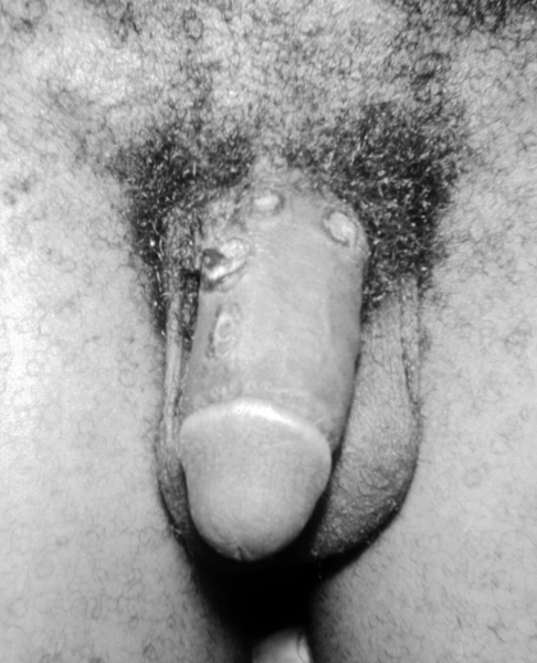 Fil:Penis syphilis.png