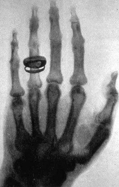 Fil:Roentgen-x-ray-von-kollikers-hand.jpg