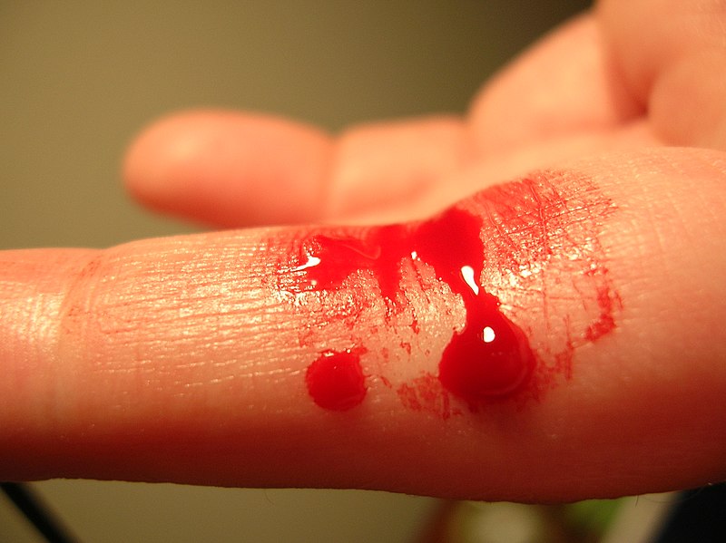 Fil:Bleeding finger.jpg