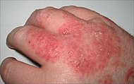 Typisk, mild dermatit